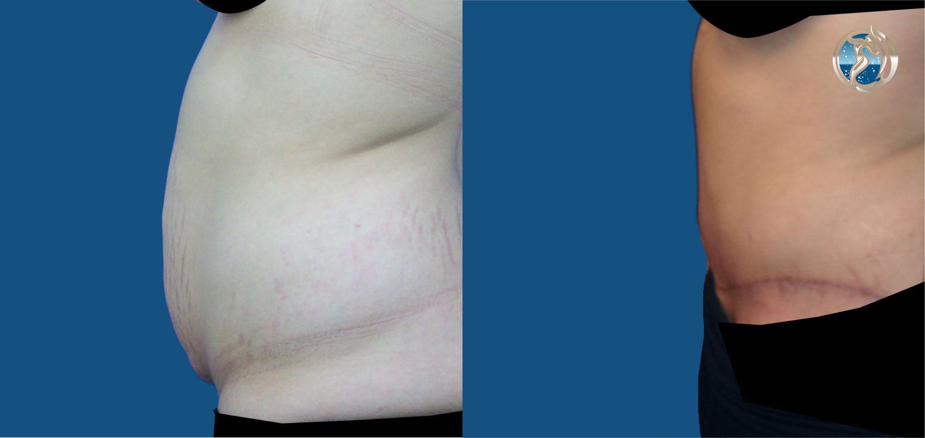 Before and after photo set of tummy tuck by Dr. Orna Fisher in San Mateo, CA - Angle 3