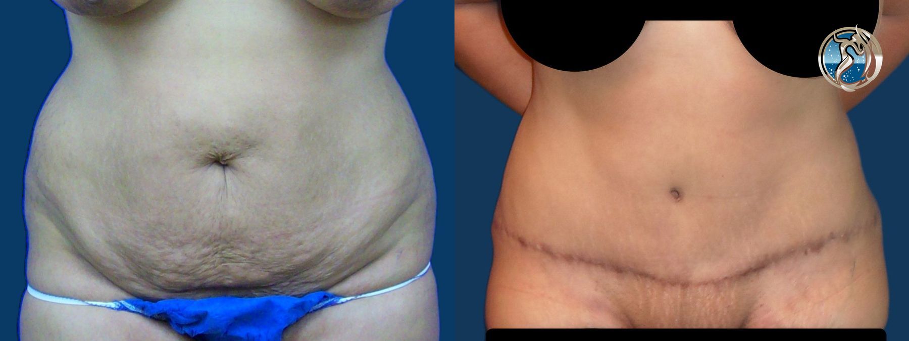 Before and after Monsplasty case 43787