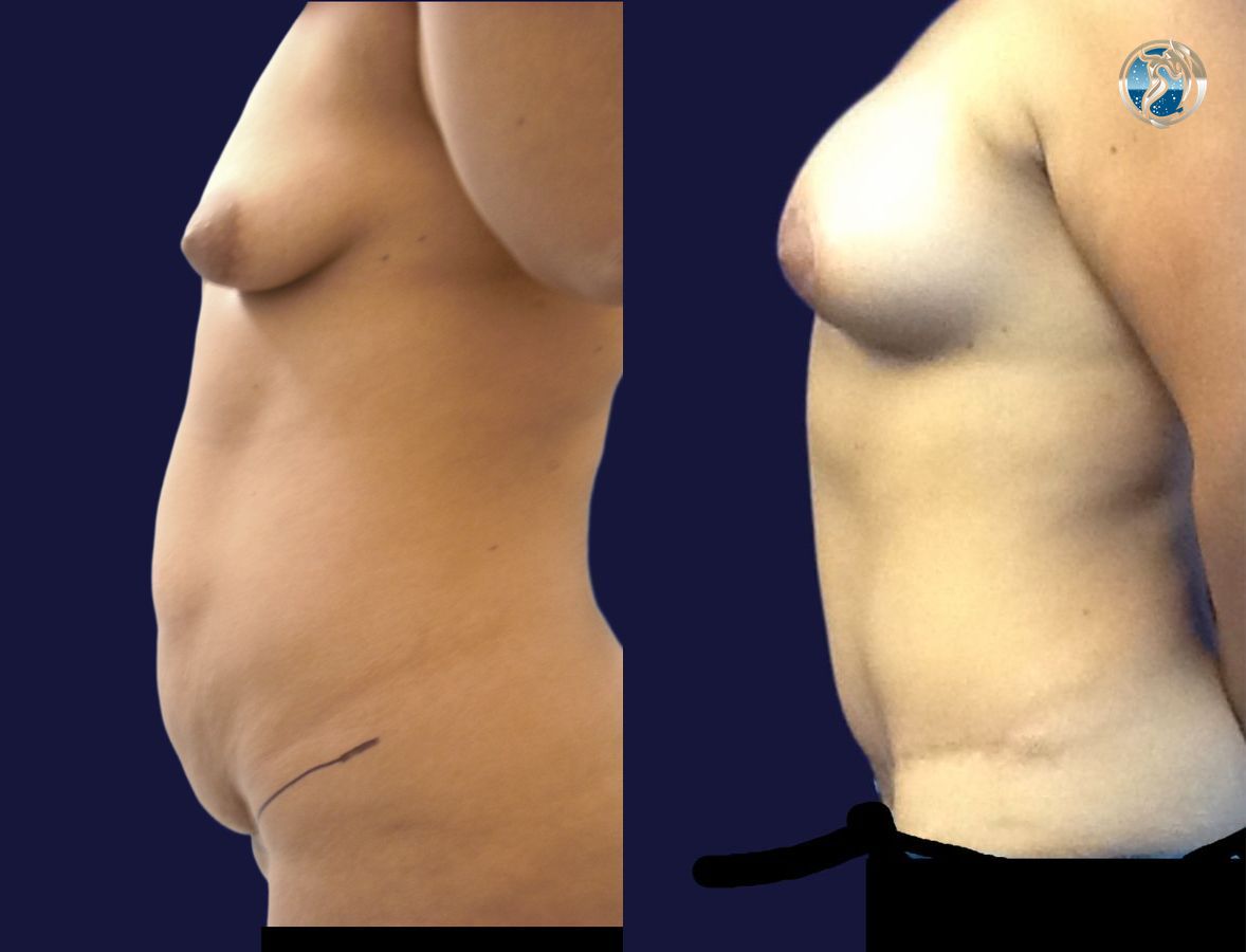 Before and after photo set of Mommy Makeover by Dr. Orna Fisher in San Mateo, CA - Angle 5