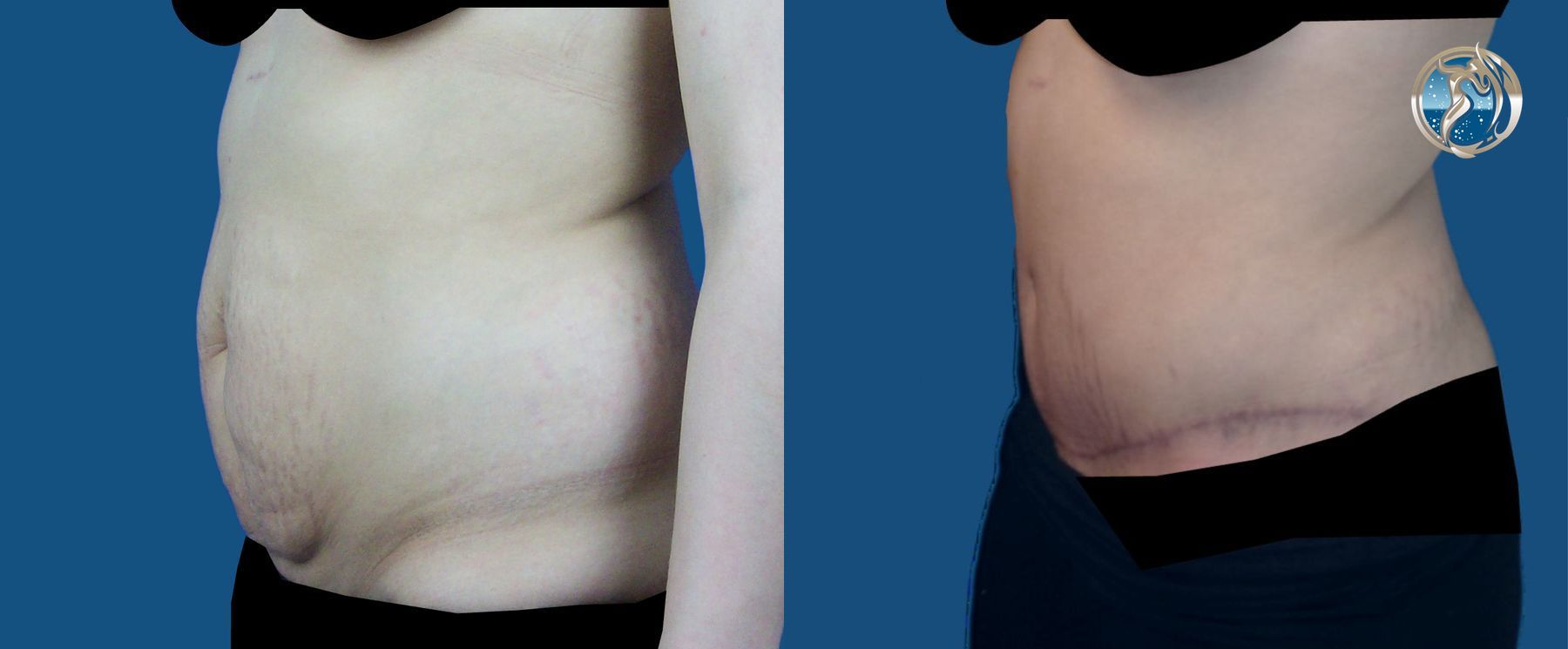 Before and after photo set of tummy tuck by Dr. Orna Fisher in San Mateo, CA - Angle 2