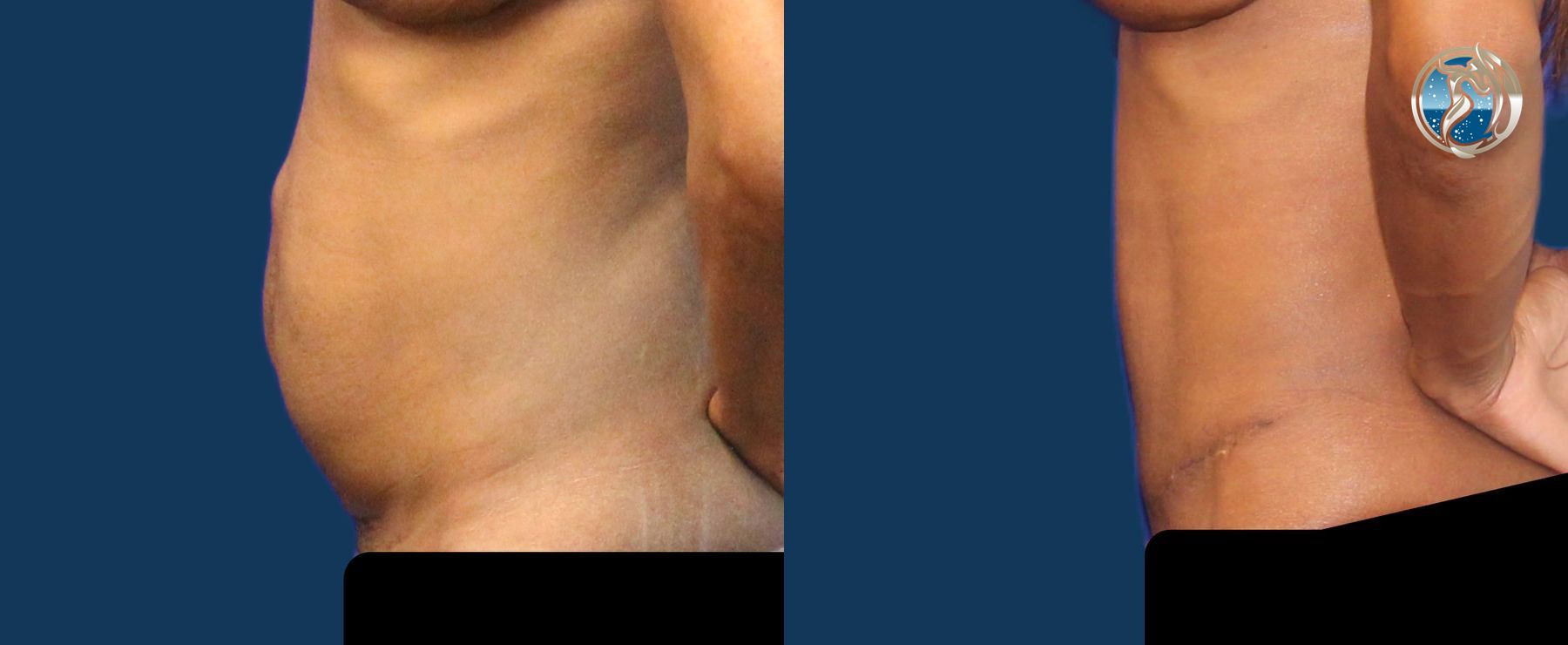Before and after Tummy Tuck case 43791 - Angle 3