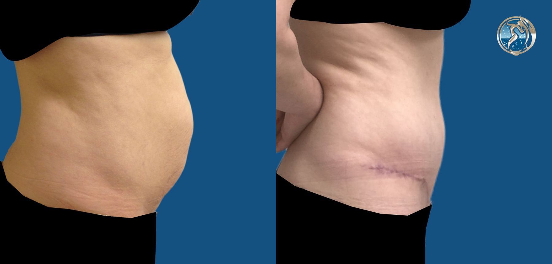 Before and after Tummy Tuck case 46038 - Angle 4