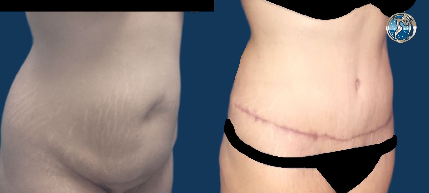 Before and after photo set of body contouring tummy tuck by Dr. Orna Fisher in San Mateo, CA - Angle 4