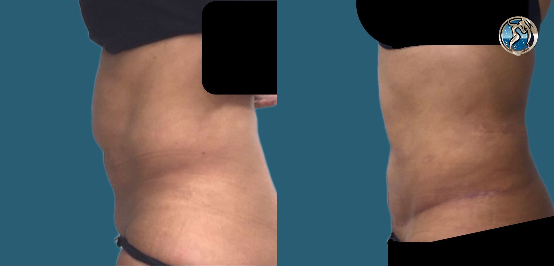 Before and after Tummy Tuck case 46061 - Angle 2