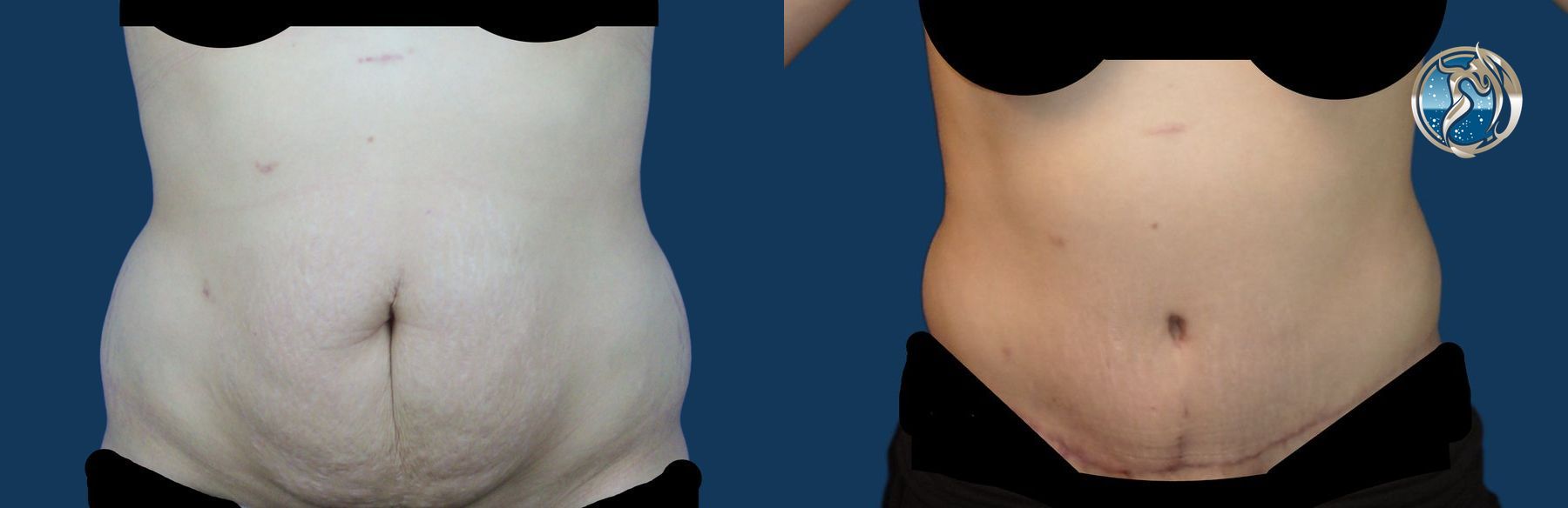 Before and after photo set of tummy tuck by Dr. Orna Fisher in San Mateo, CA
