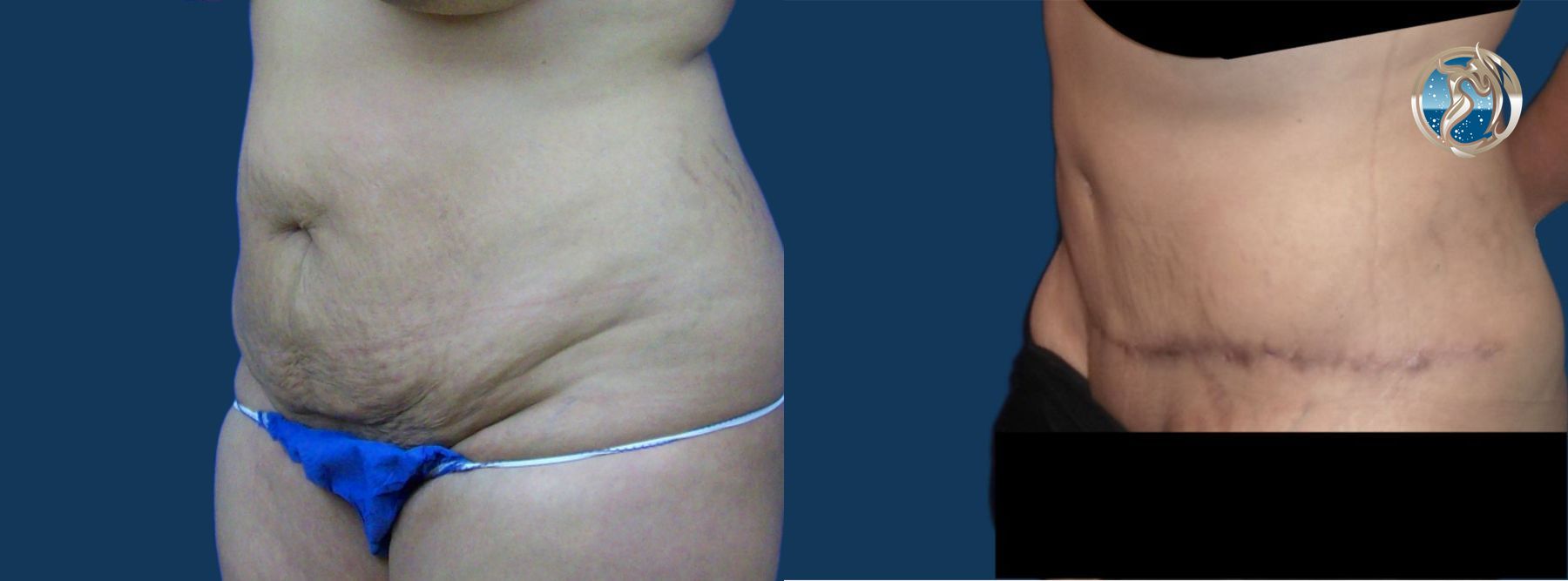 Before and after Monsplasty case 43787 - Angle 4