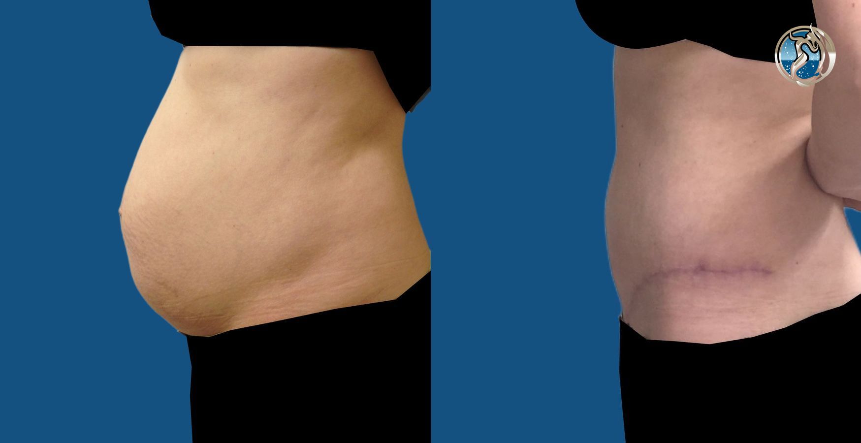 Before and after Tummy Tuck case 46038 - Angle 2