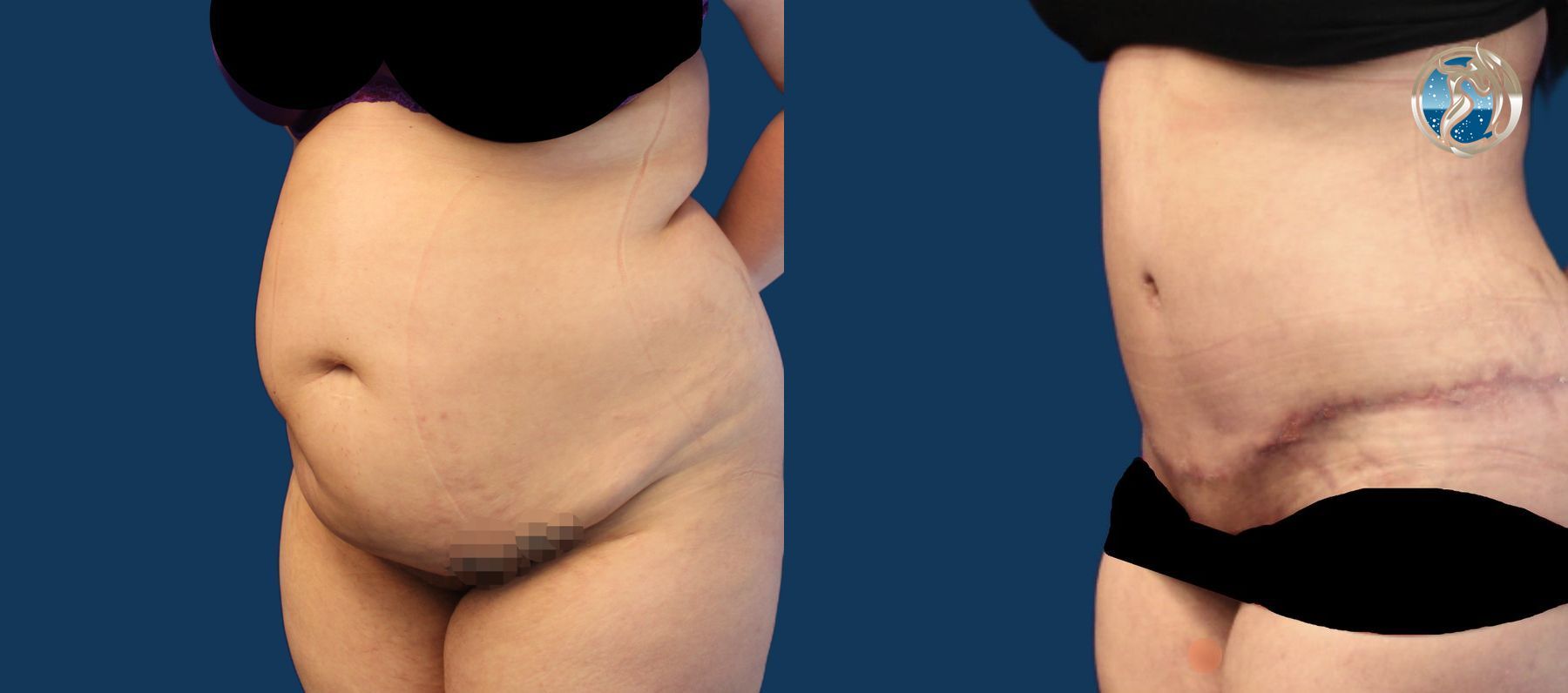 Before and after photo set of Abdominoplasty with lipo by Dr. Orna Fisher in San Mateo, CA - Angle 4