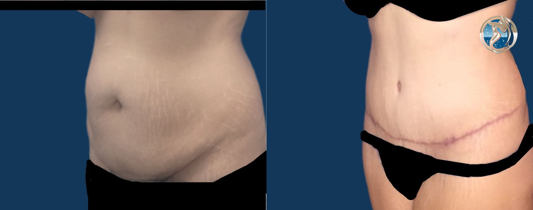 Before and after photo set of body contouring tummy tuck by Dr. Orna Fisher in San Mateo, CA - Angle 2