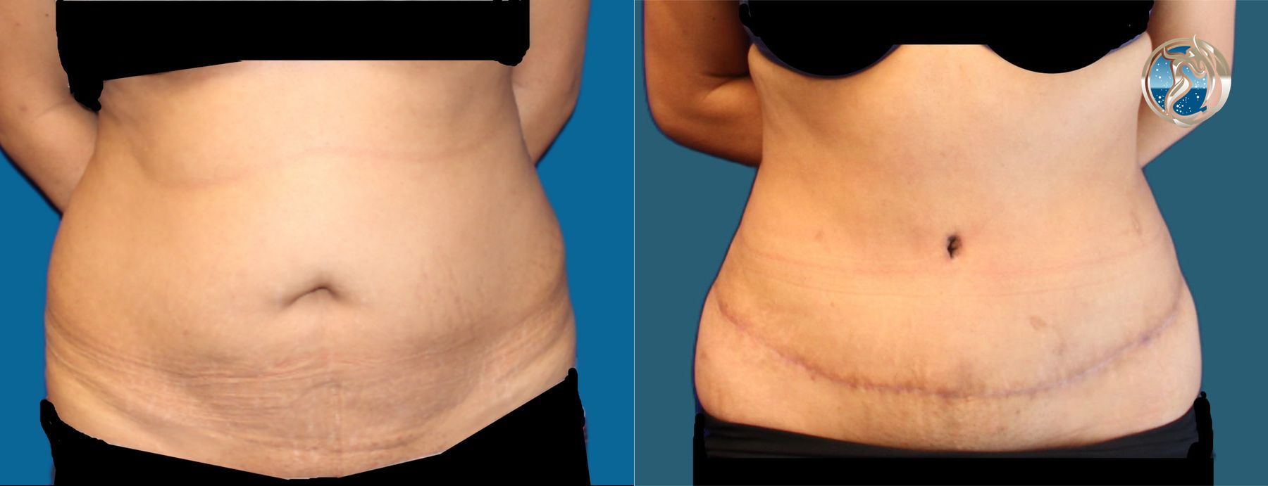 photos of tummy tuck and waist liposuction by Dr. Orna Fisher in San Mateo, CA
