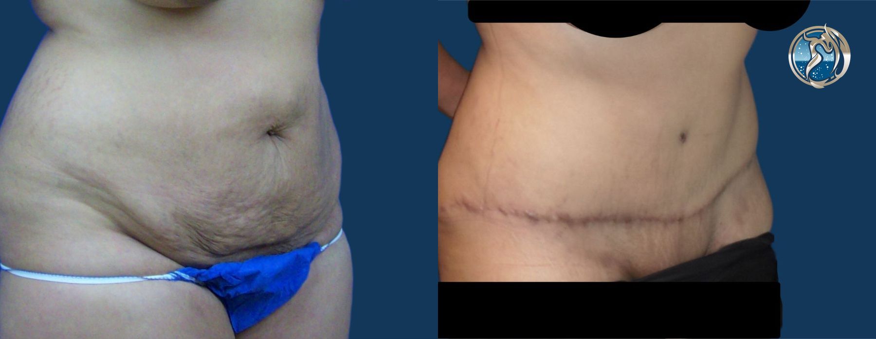 Before and after Monsplasty case 43787 - Angle 2