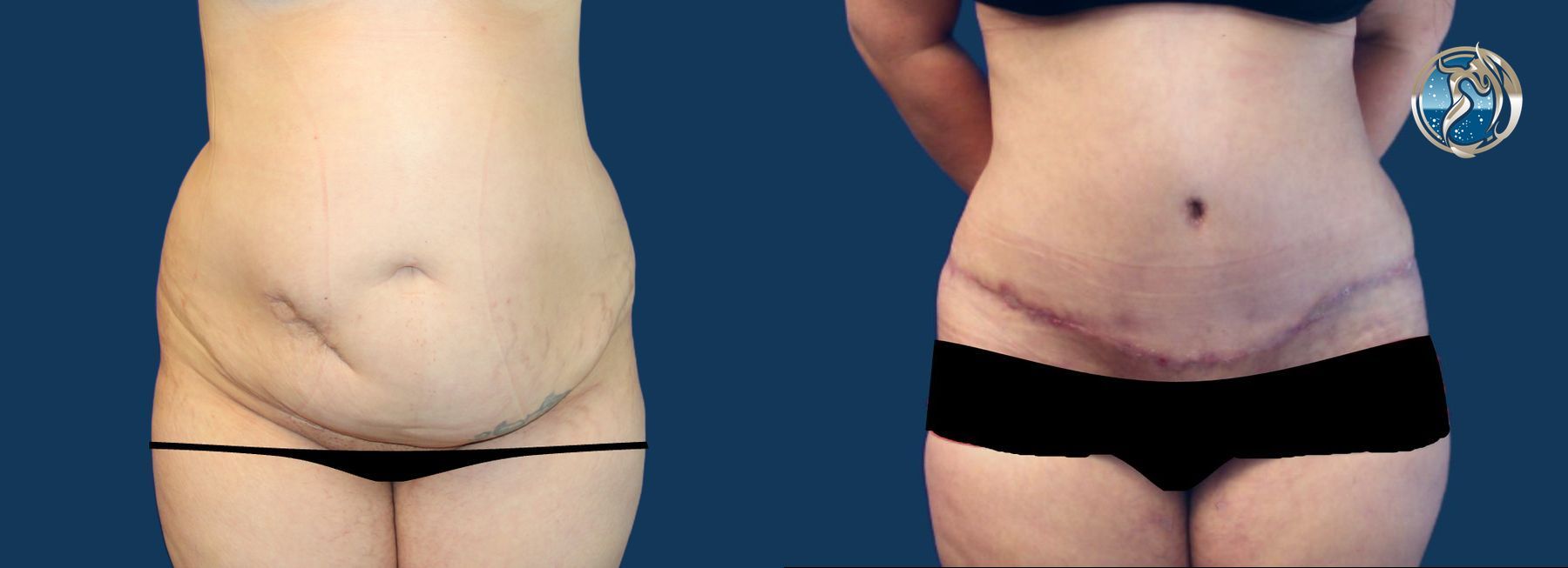 Before and after photo set of Abdominoplasty with lipo by Dr. Orna Fisher in San Mateo, CA