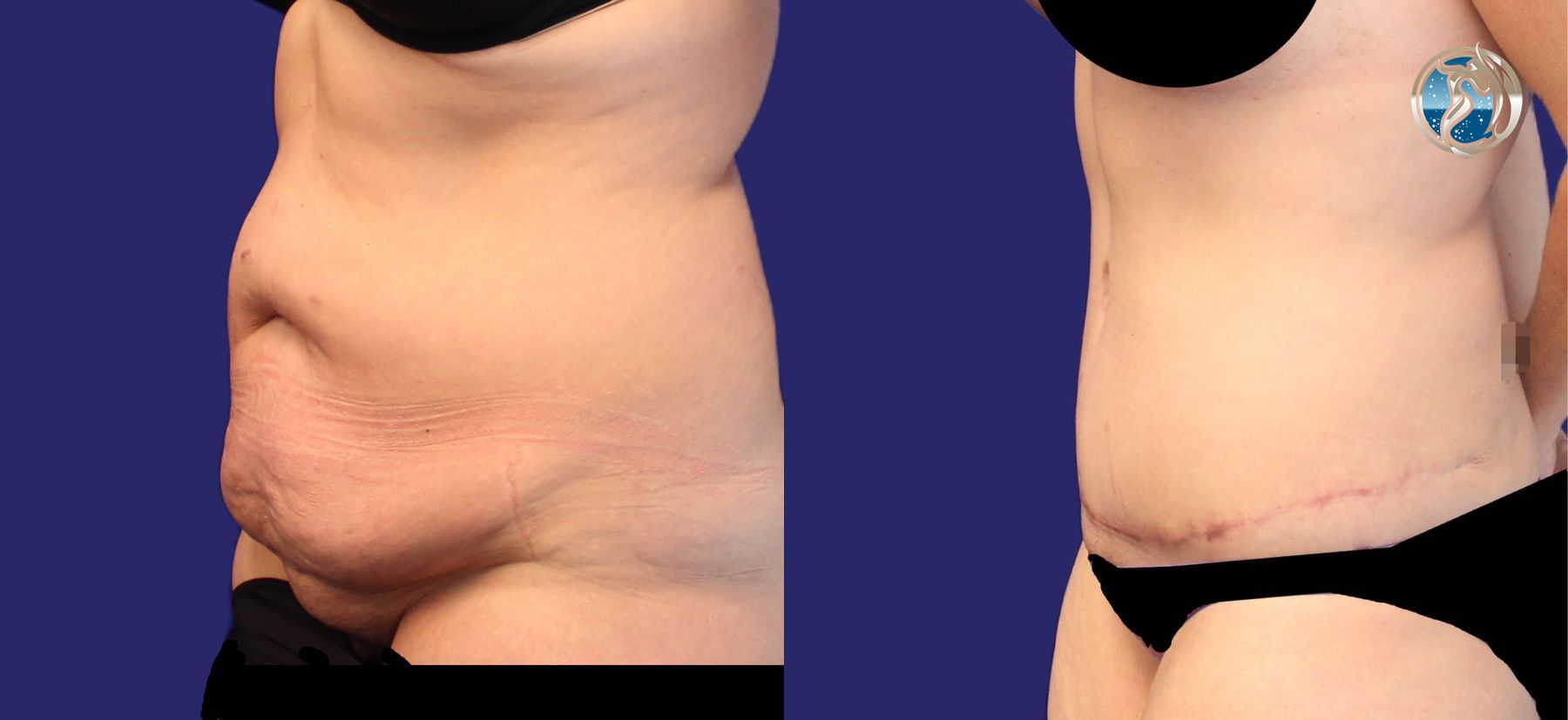 Before and after photo set of tummy tuck after weight loss by Dr. Orna Fisher in San Mateo, CA - Angle 2