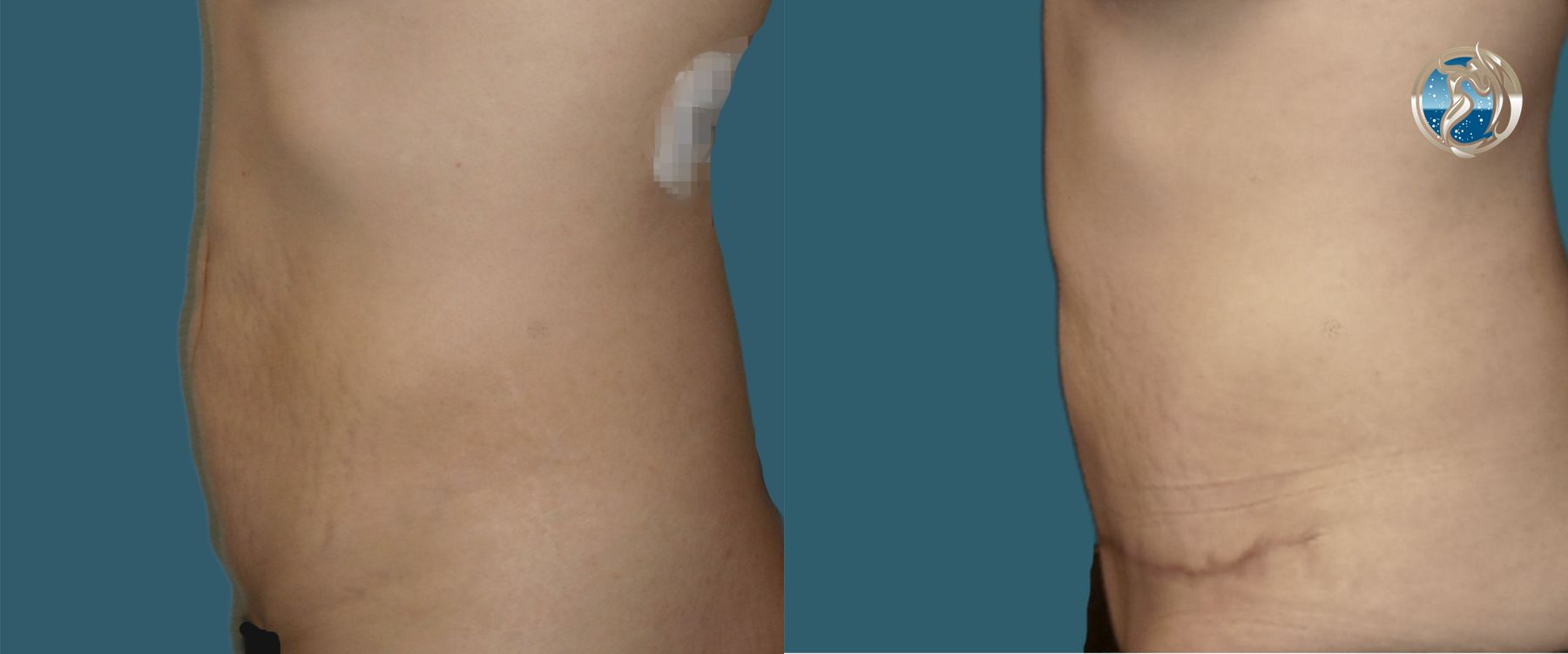 Before and after photo set of tummy tuck by Dr. Orna Fisher in San Mateo, CA - Angle 2