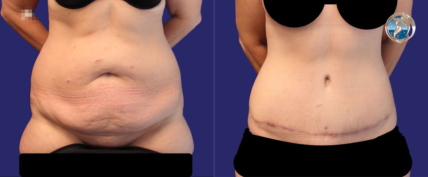 Before and after photo set of tummy tuck after weight loss by Dr. Orna Fisher in San Mateo, CA