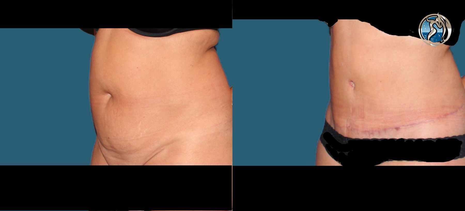 Before and after photo set of tummy tuck with lipo by Dr. Orna Fisher in San Mateo, CA - Angle 2
