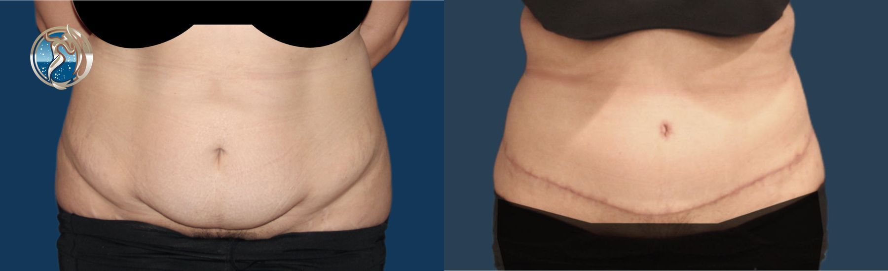Before and after Tummy Tuck case 43754
