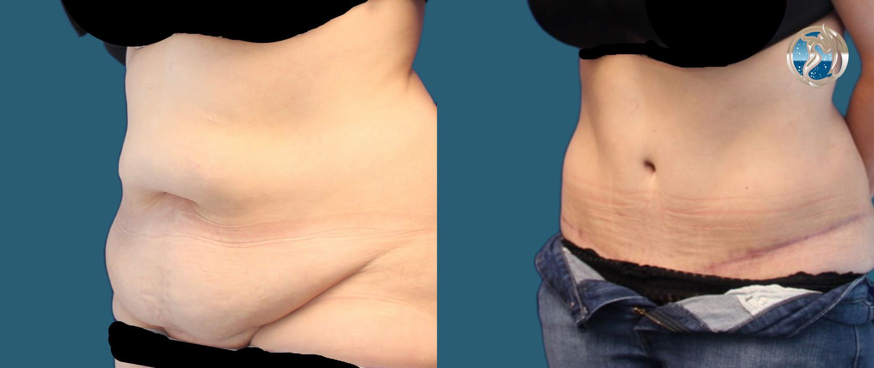 Before and after photo set of tummy tuck with lipo by Dr. Orna Fisher in San Mateo, CA - Angle 3