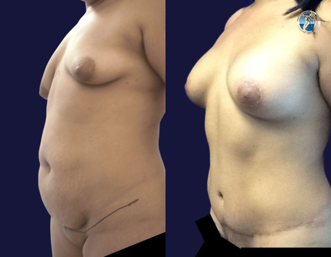 Before and after photo set of Mommy Makeover by Dr. Orna Fisher in San Mateo, CA - Angle 4