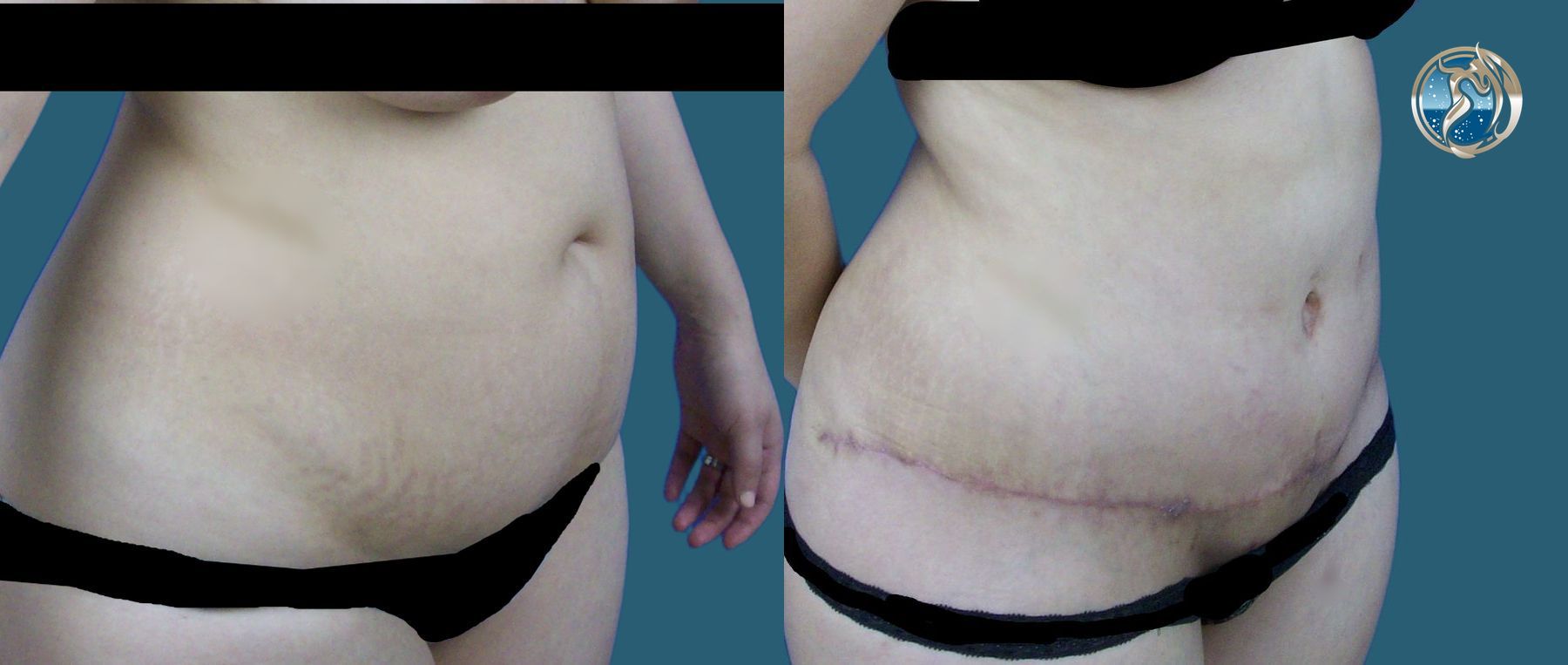 Before and after Liposuction and BodyTite minimally invasive surgical tightening case 43771 - Angle 2