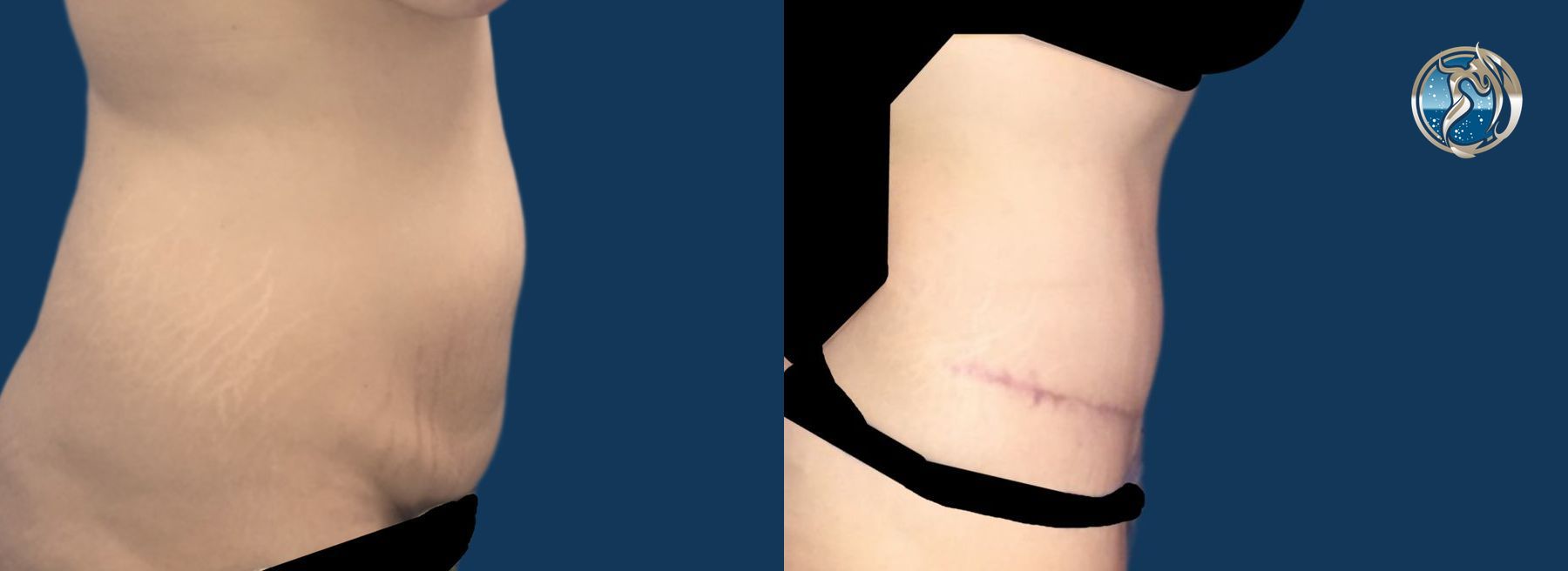 Before and after photo set of body contouring tummy tuck by Dr. Orna Fisher in San Mateo, CA - Angle 5
