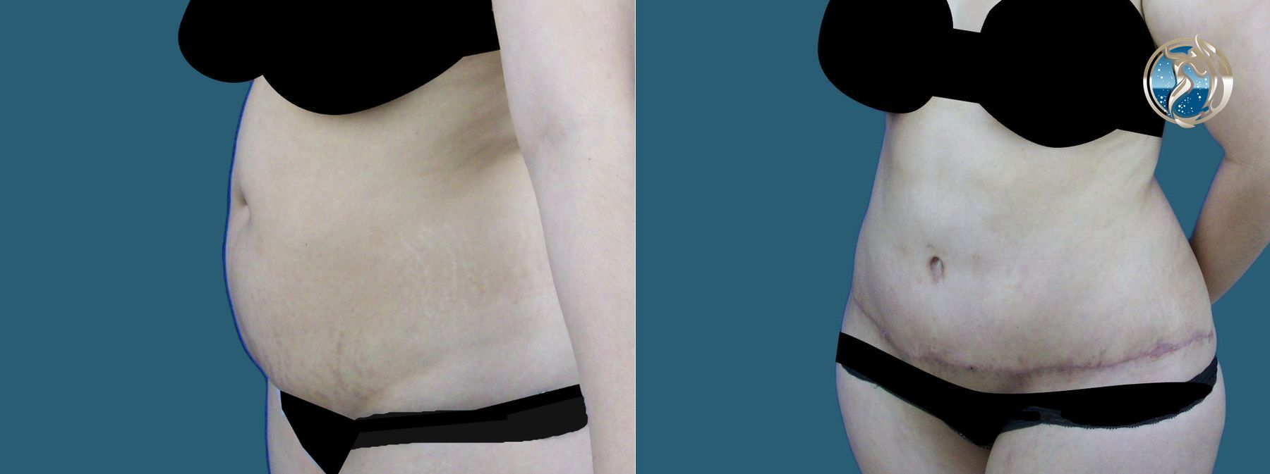 Before and after Liposuction and BodyTite minimally invasive surgical tightening case 43771 - Angle 4
