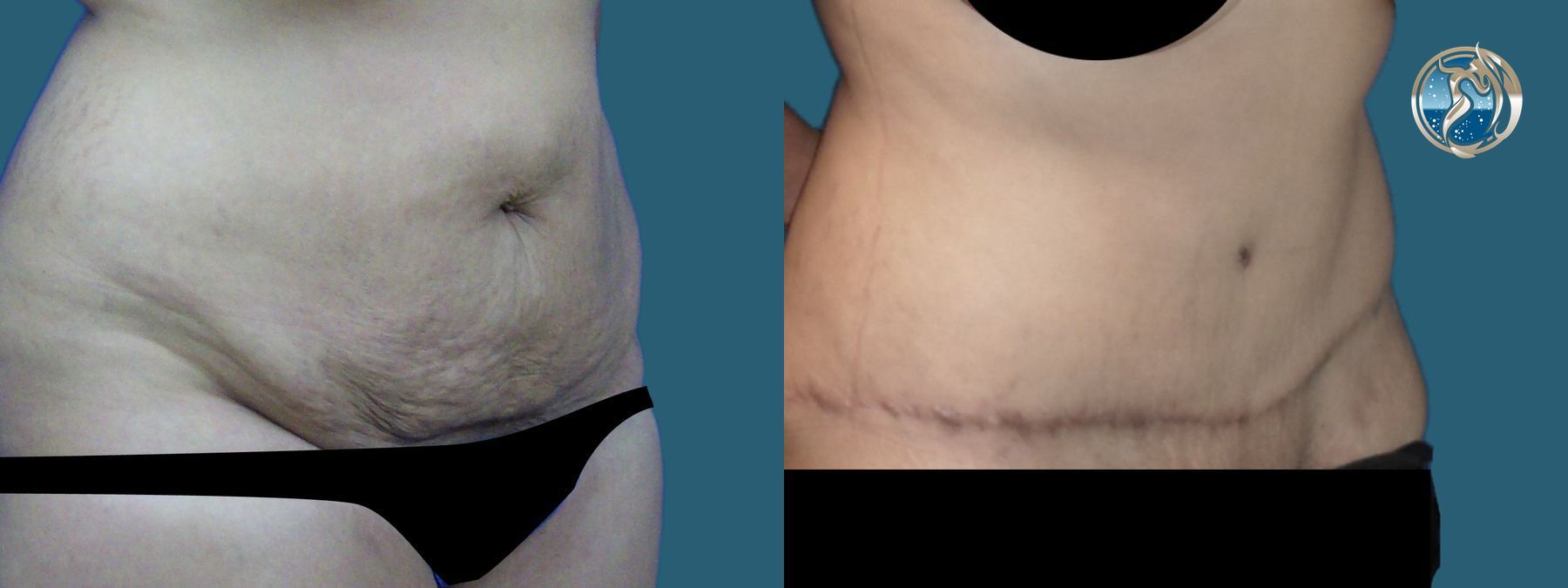 Before and after photo set of tummy tuck with lipo by Dr. Orna Fisher in San Mateo, CA - Angle 3