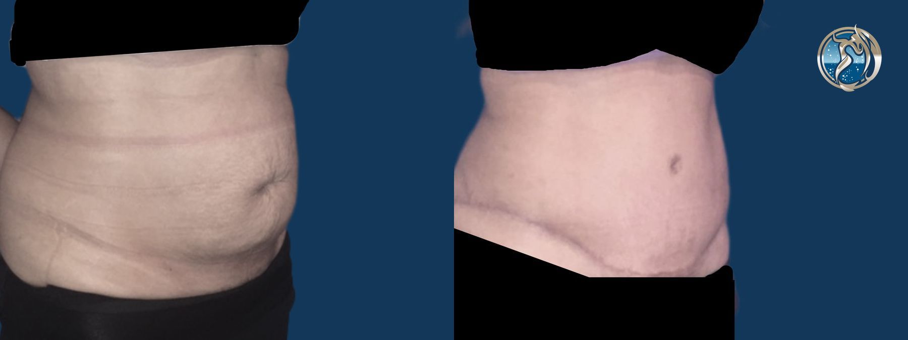 Before and after Tummy Tuck case 46095 - Angle 4