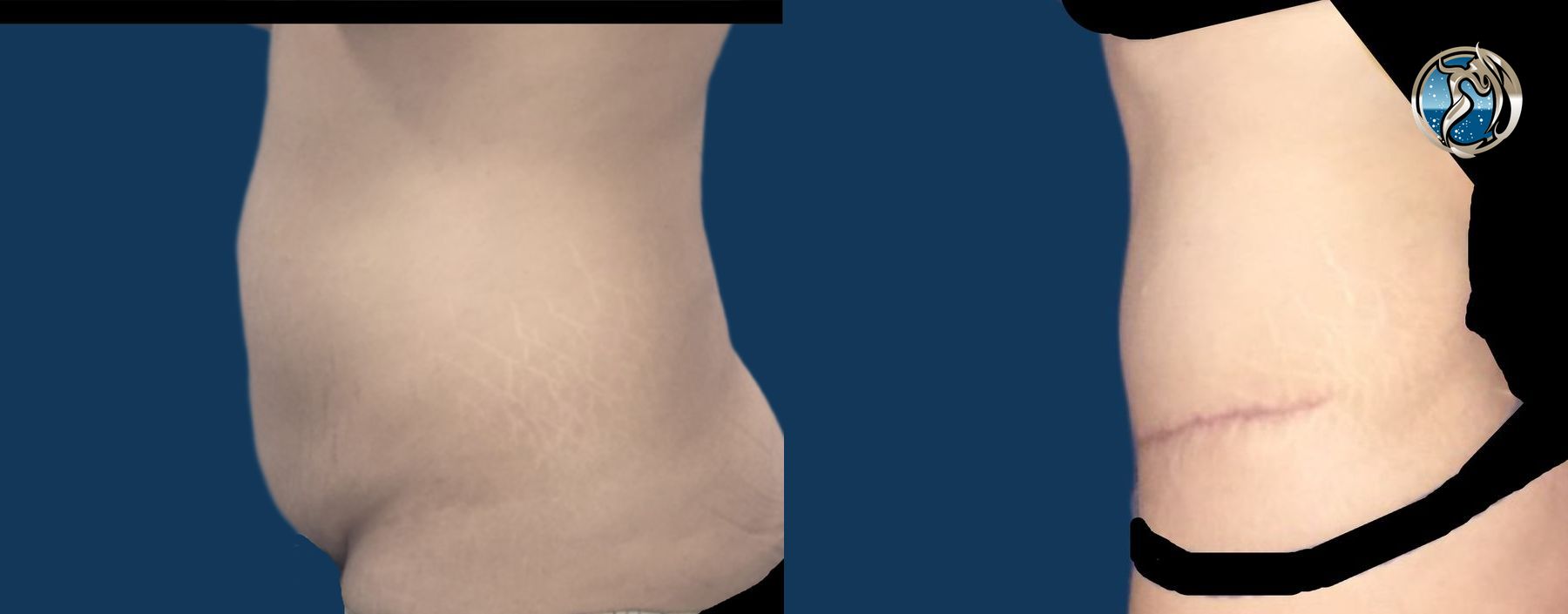 Before and after photo set of body contouring tummy tuck by Dr. Orna Fisher in San Mateo, CA - Angle 3