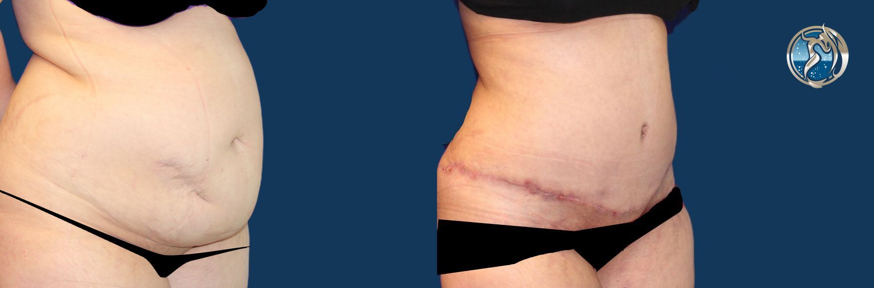 Before and after photo set of Abdominoplasty with lipo by Dr. Orna Fisher in San Mateo, CA - Angle 2