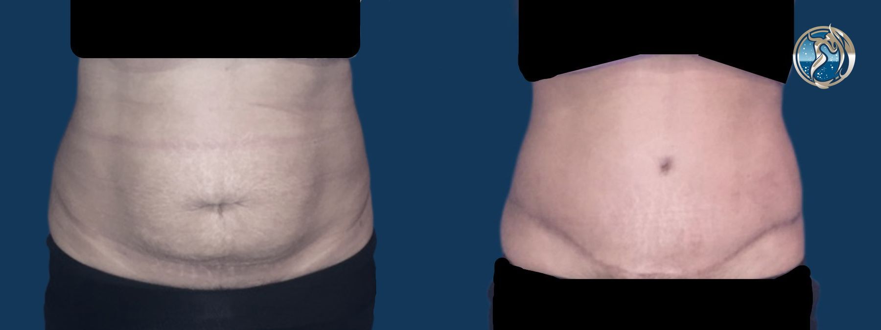 Before and after Tummy Tuck case 46095