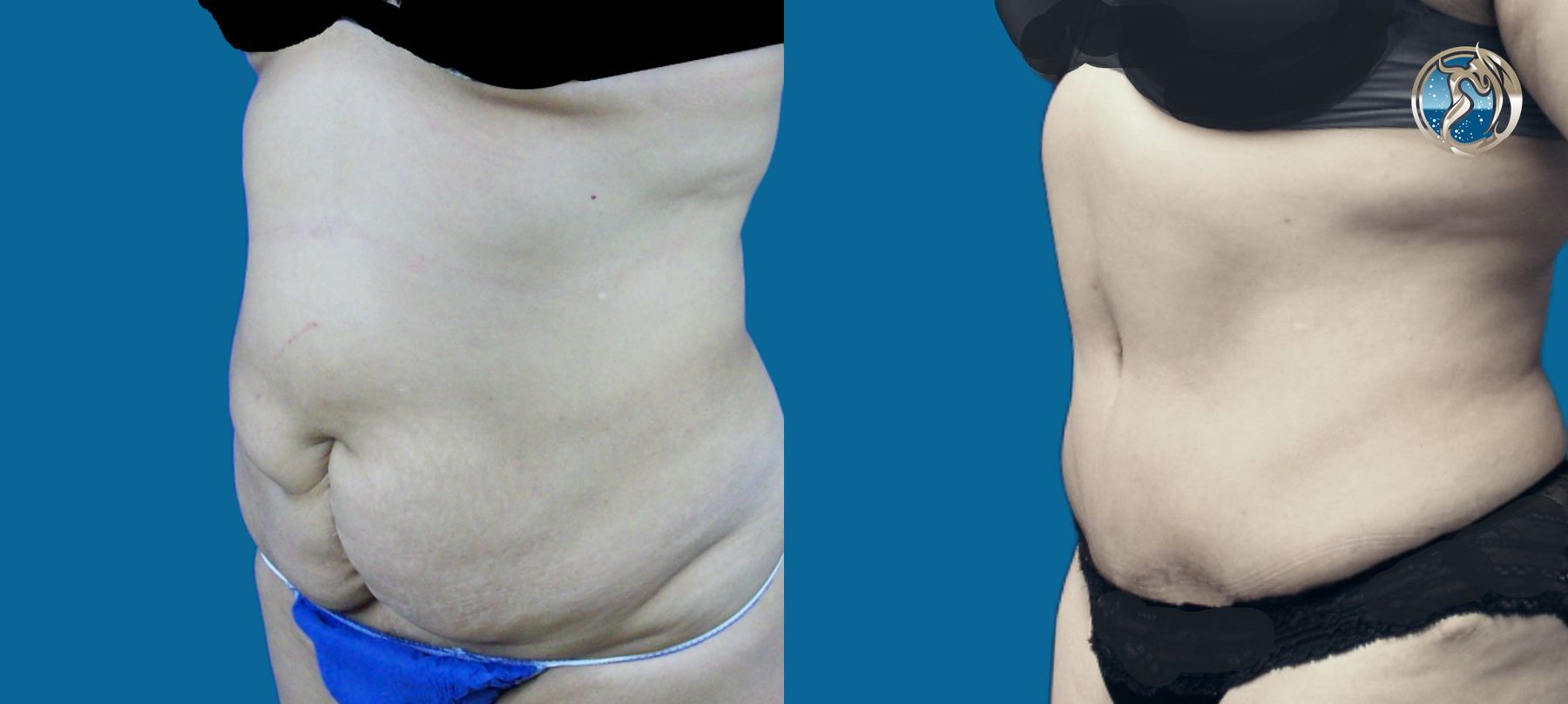 Before and after photo set of body contouring tummy tuck by Dr. Orna Fisher in San Mateo, CA - Angle 2
