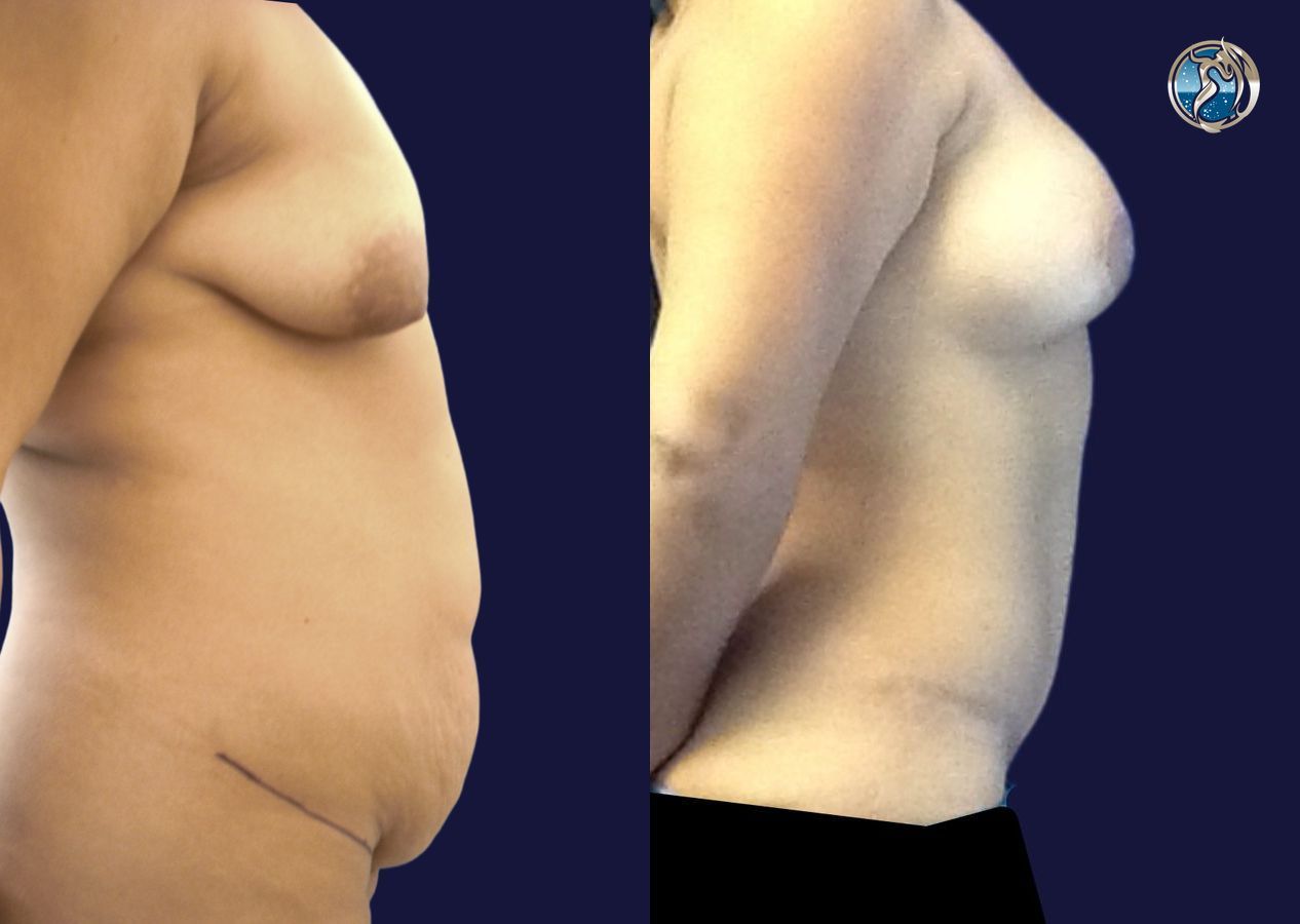 Before and after photo set of Mommy Makeover by Dr. Orna Fisher in San Mateo, CA - Angle 3