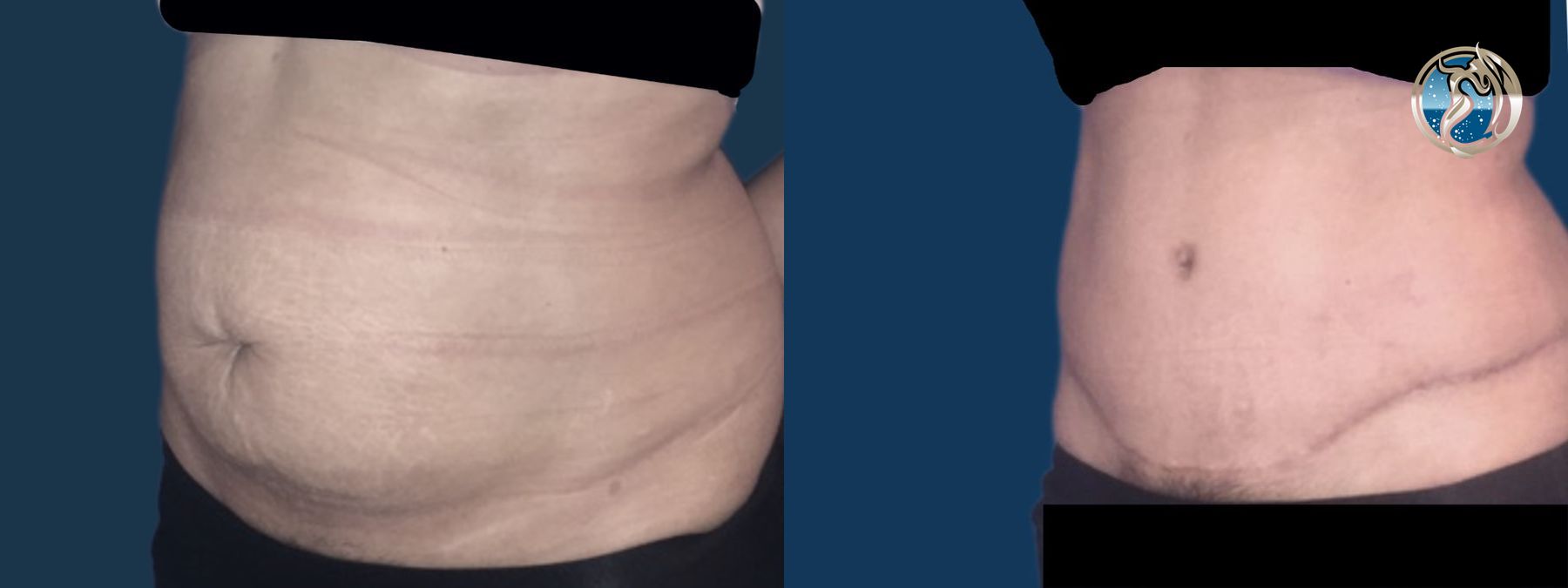 Before and after Tummy Tuck case 46095 - Angle 2