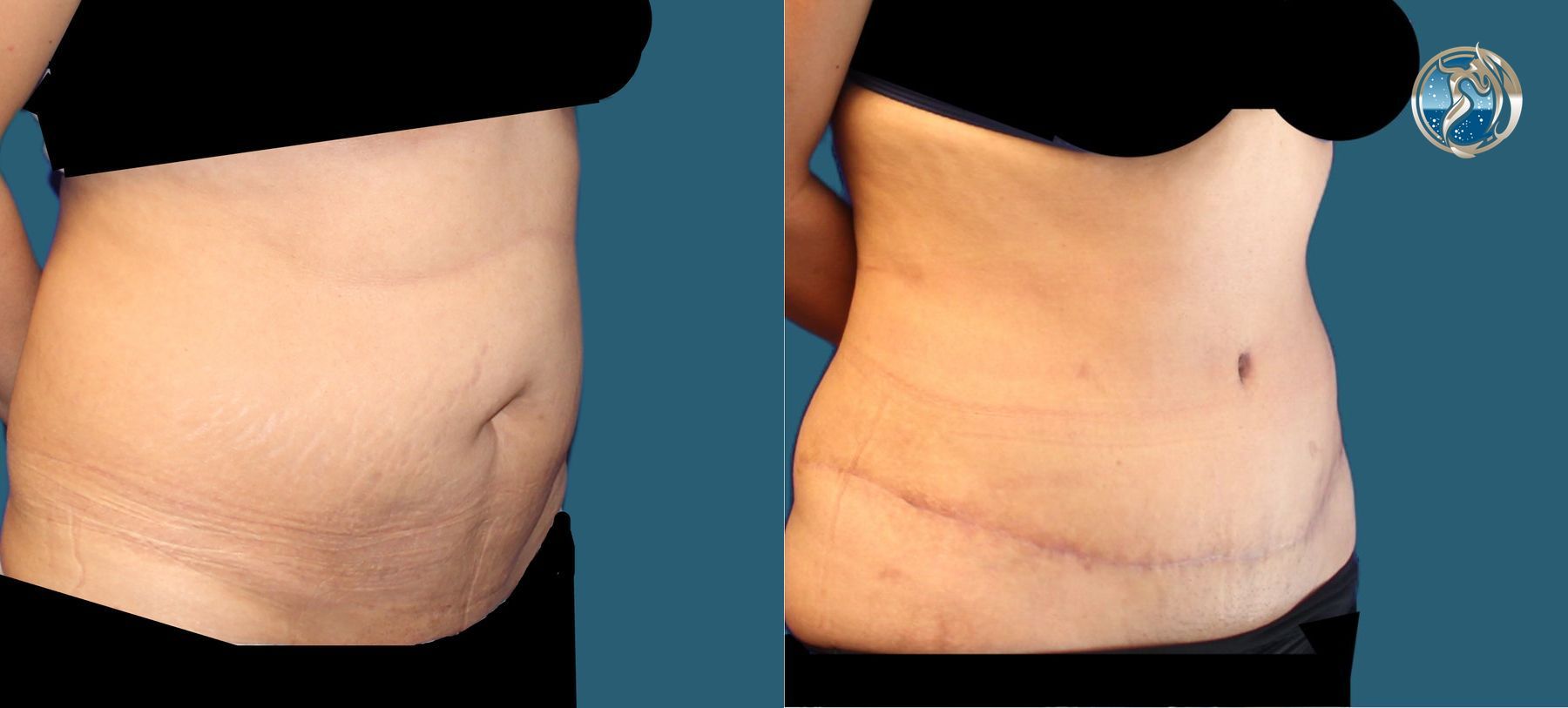 photos of tummy tuck and waist liposuction by Dr. Orna Fisher in San Mateo, CA - Angle 4
