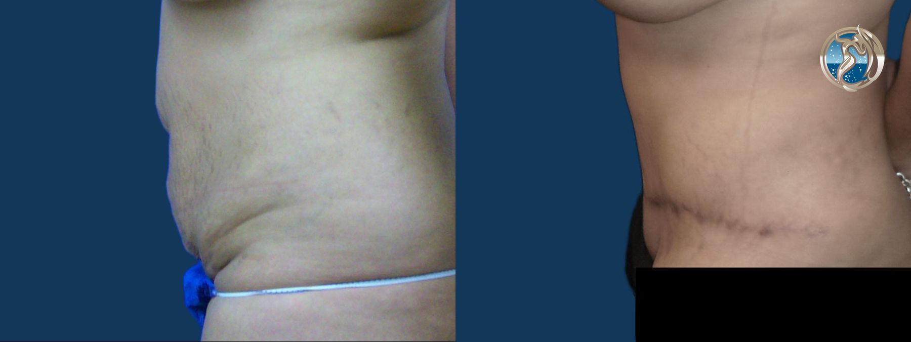 Before and after Monsplasty case 43787 - Angle 5