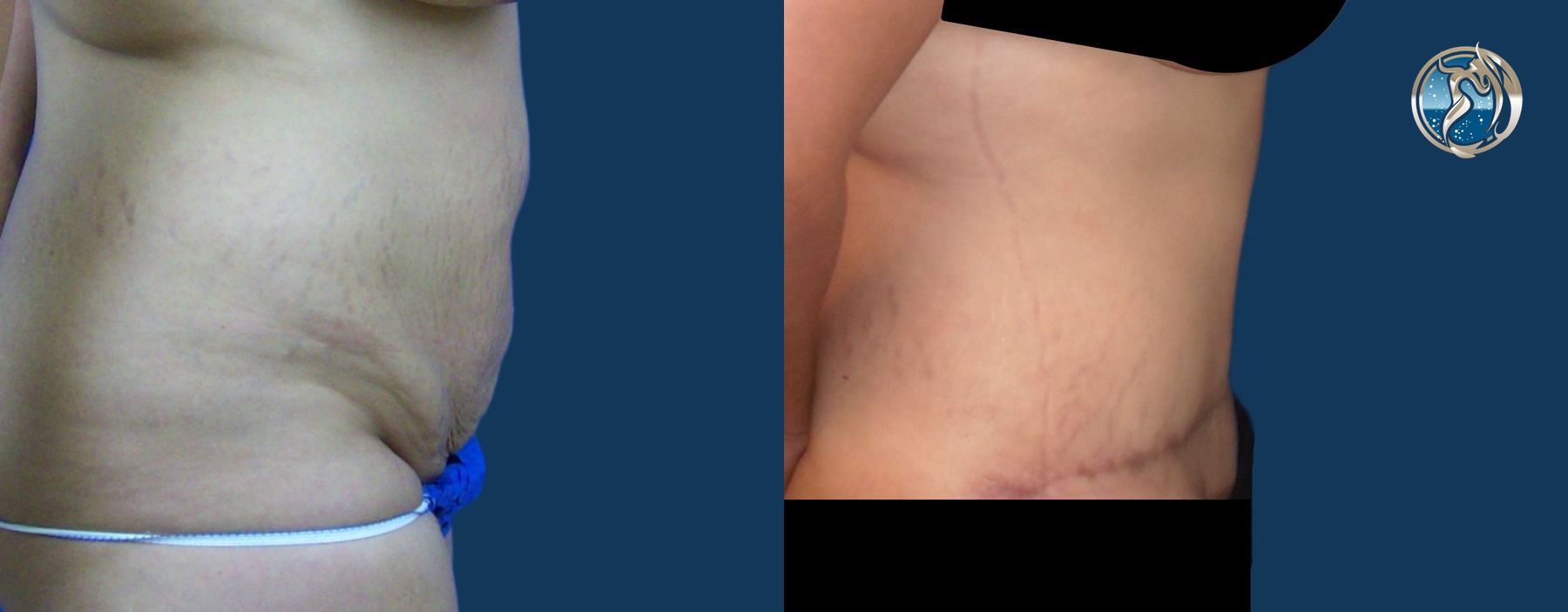 Before and after Monsplasty case 43787 - Angle 3