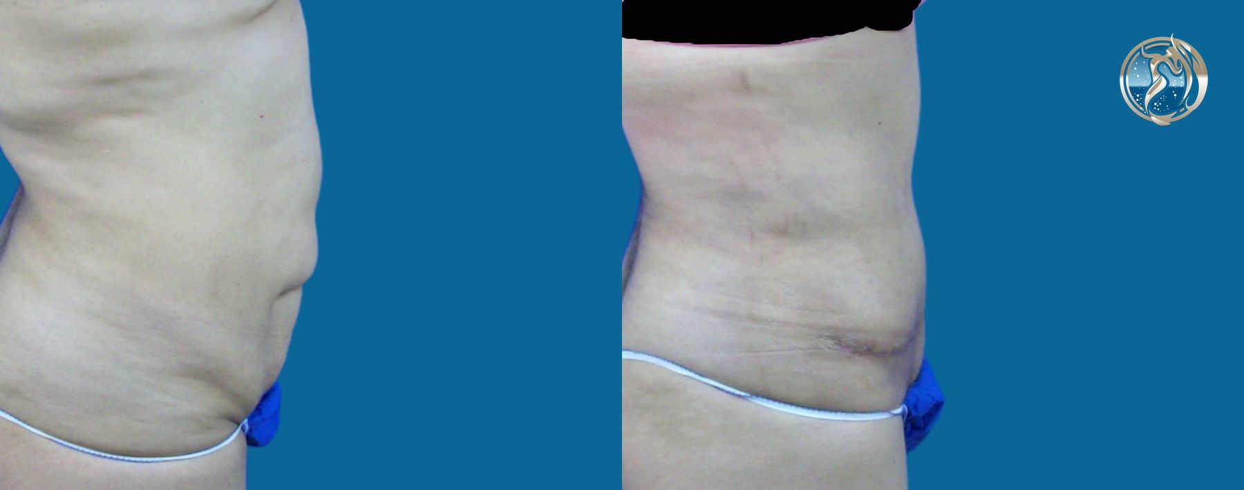 Before and after photo set of body contouring tummy tuck by Dr. Orna Fisher in San Mateo, CA - Angle 5