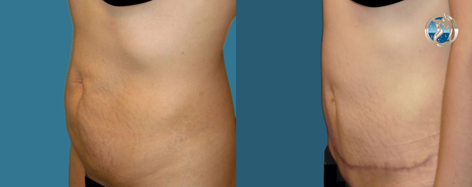 Before and after photo set of tummy tuck by Dr. Orna Fisher in San Mateo, CA