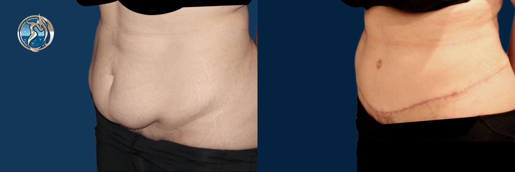 Before and after Tummy Tuck case 43754 - Angle 2