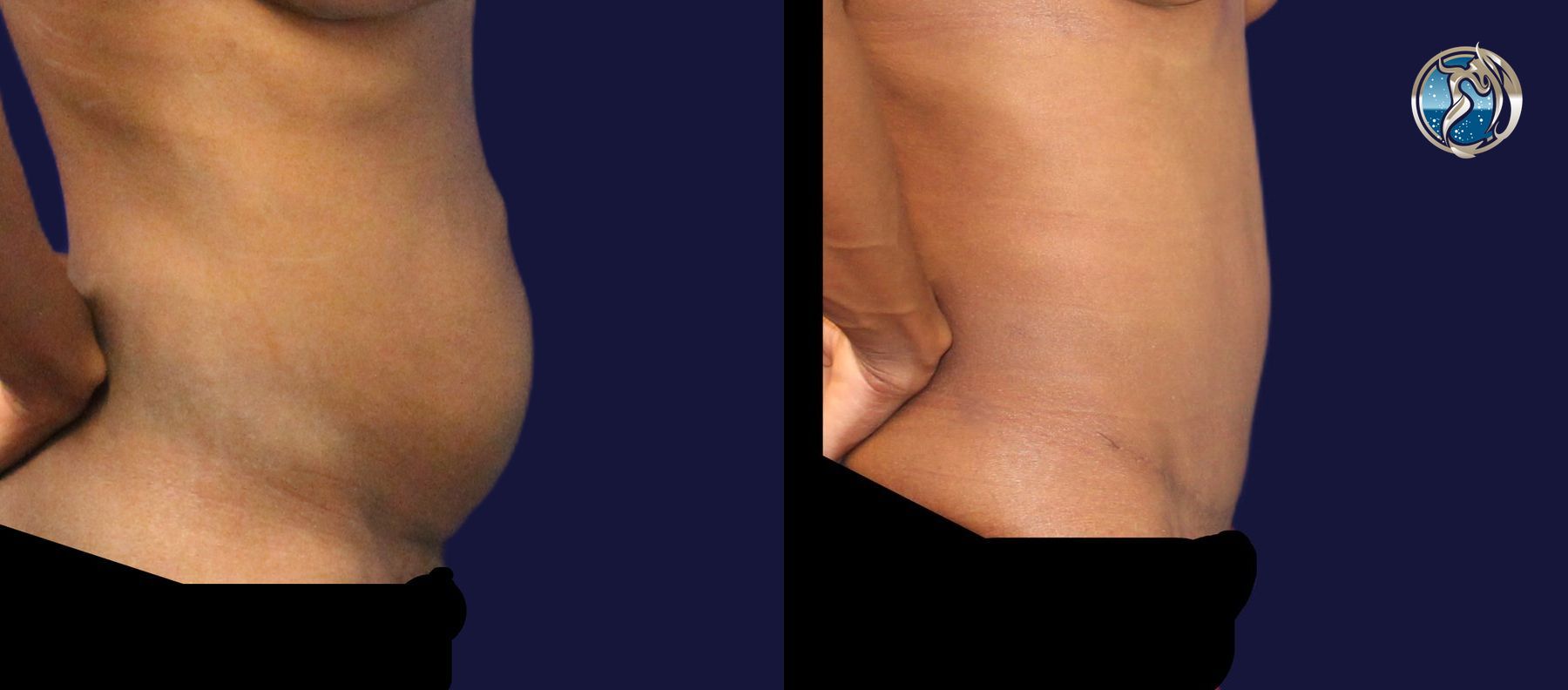 Before and after Tummy Tuck case 43791 - Angle 5