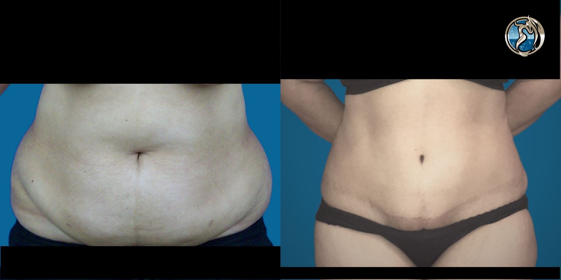 Before and after photo set of tummy tuck by Dr. Orna Fisher in San Mateo, CA