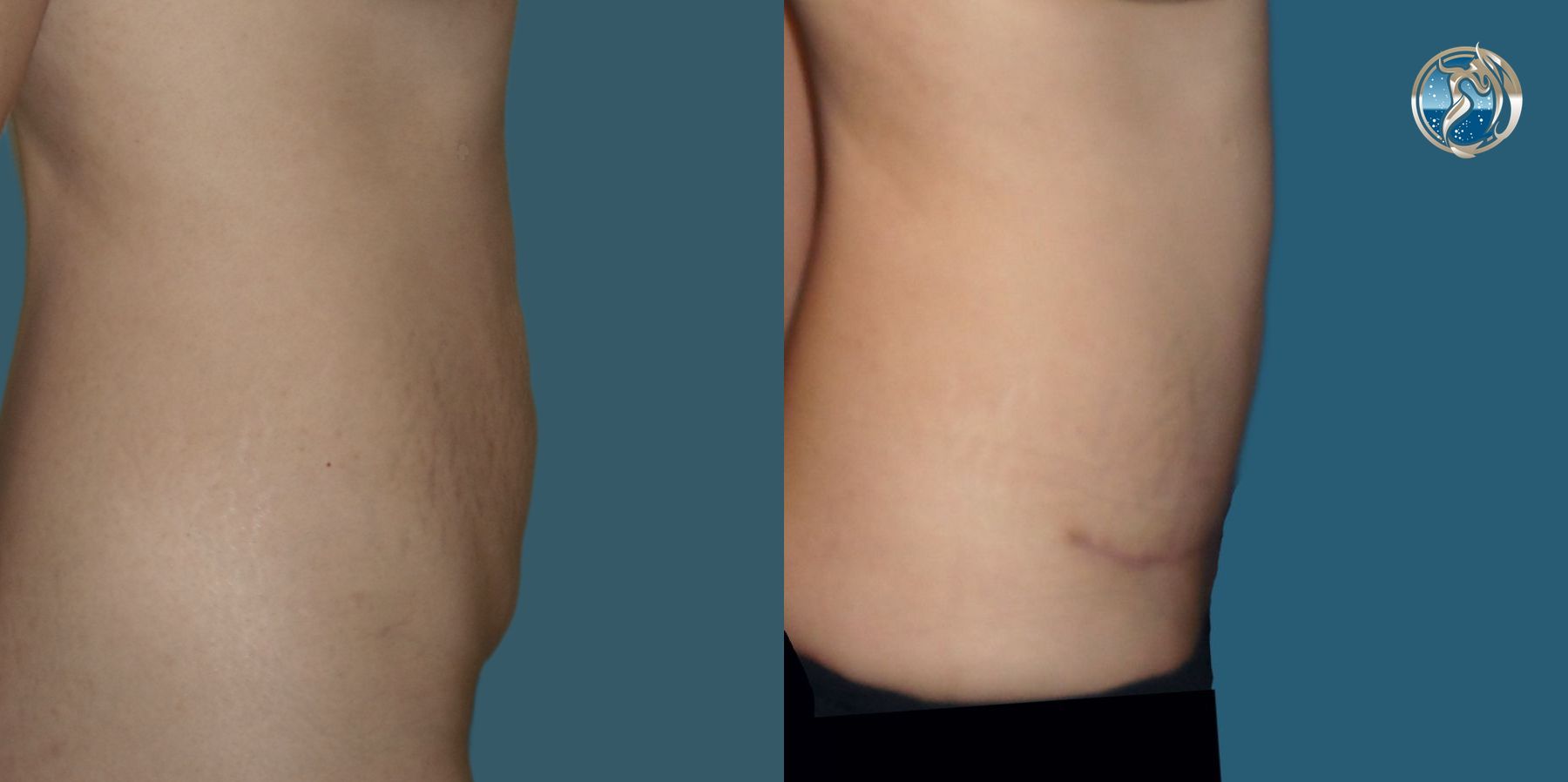 Before and after photo set of tummy tuck by Dr. Orna Fisher in San Mateo, CA - Angle 3