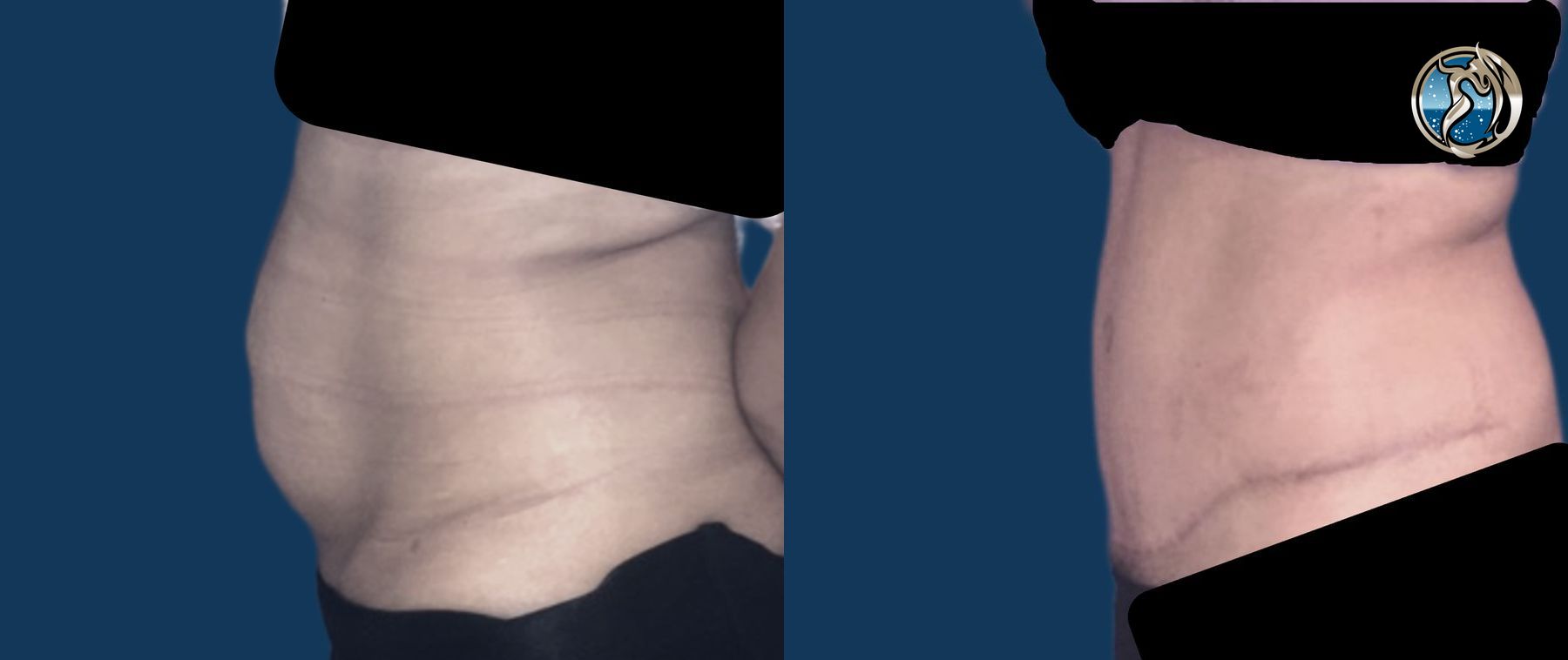 Before and after Tummy Tuck case 46095 - Angle 3