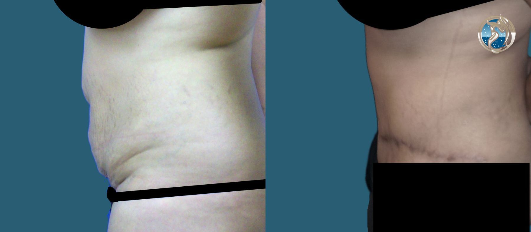 Before and after photo set of tummy tuck with lipo by Dr. Orna Fisher in San Mateo, CA - Angle 4