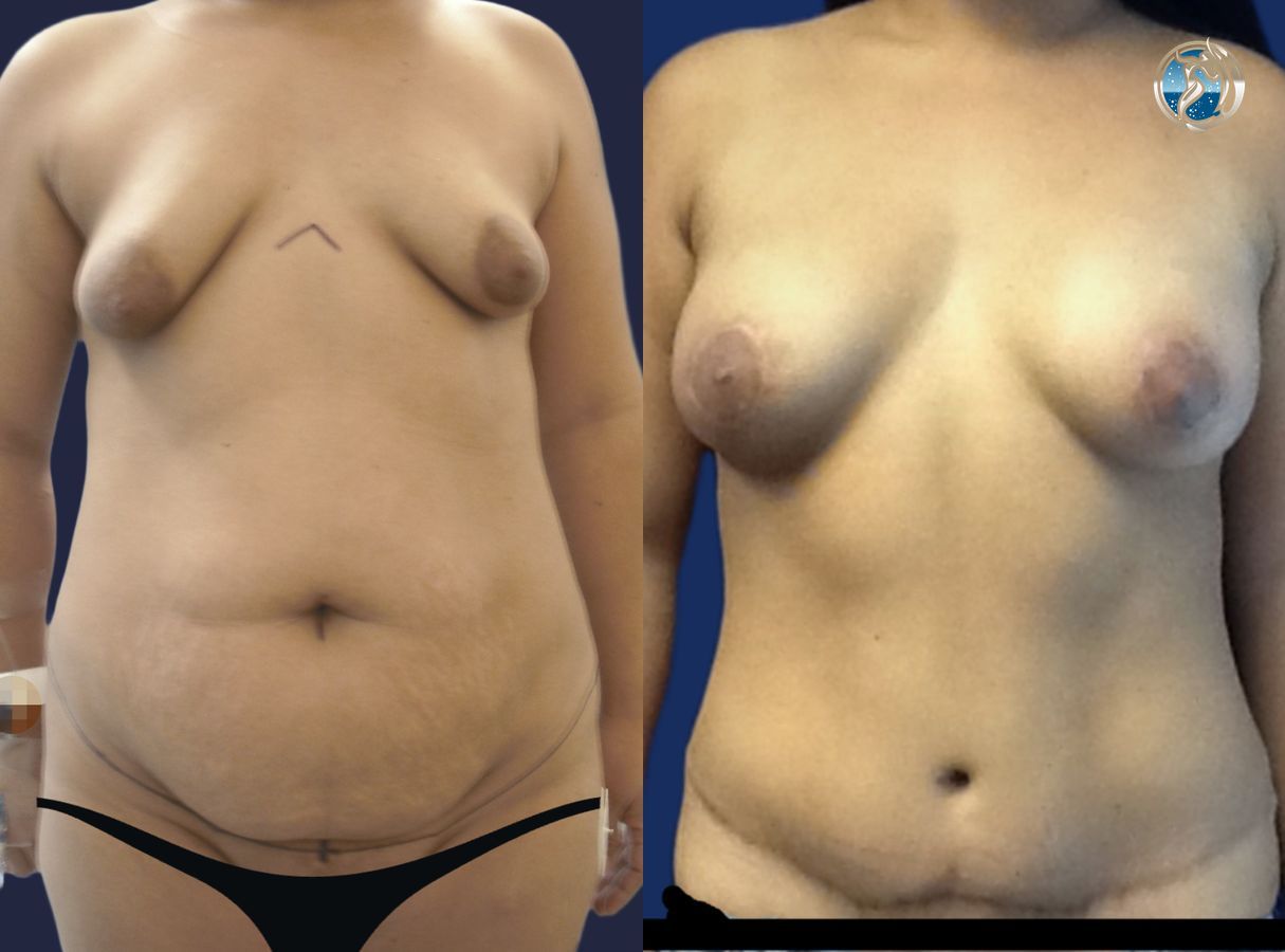 Before and after photo set of Mommy Makeover by Dr. Orna Fisher in San Mateo, CA
