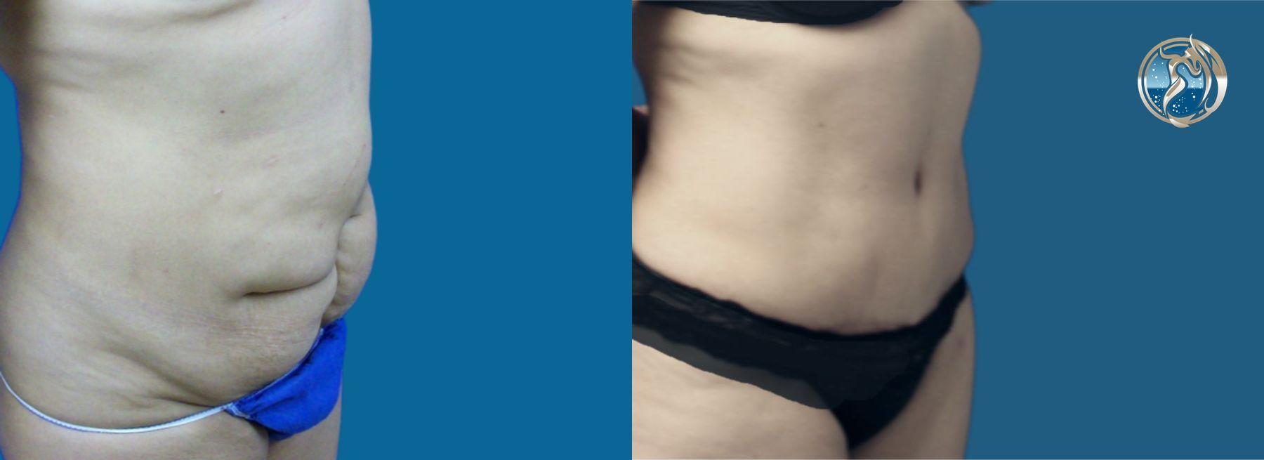 Before and after photo set of body contouring tummy tuck by Dr. Orna Fisher in San Mateo, CA - Angle 4