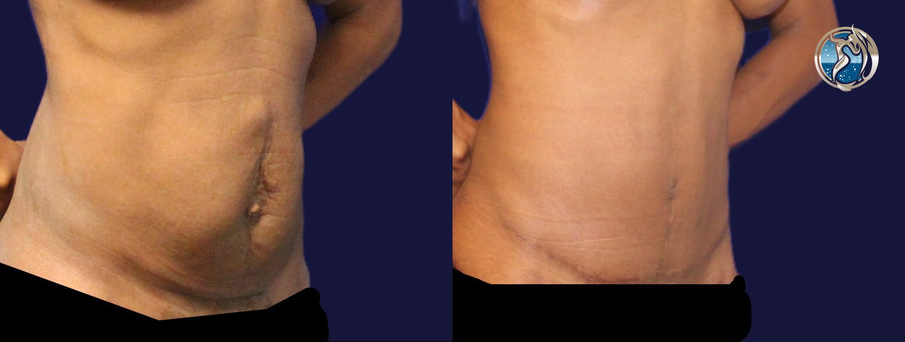 Before and after Tummy Tuck case 43791 - Angle 4