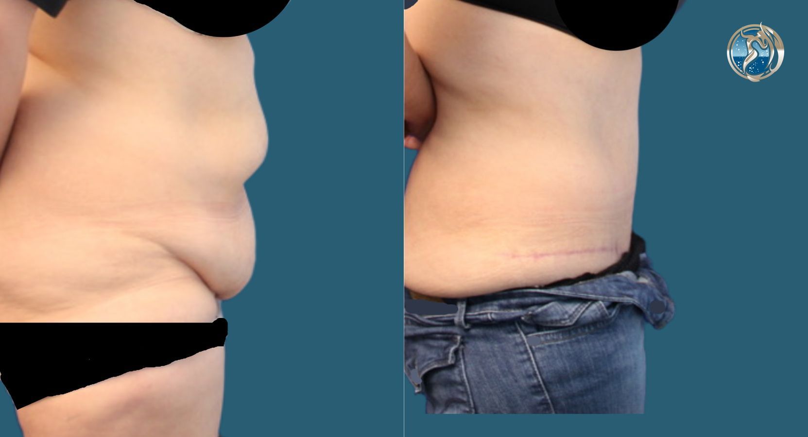 Before and after photo set of tummy tuck with lipo by Dr. Orna Fisher in San Mateo, CA - Angle 2
