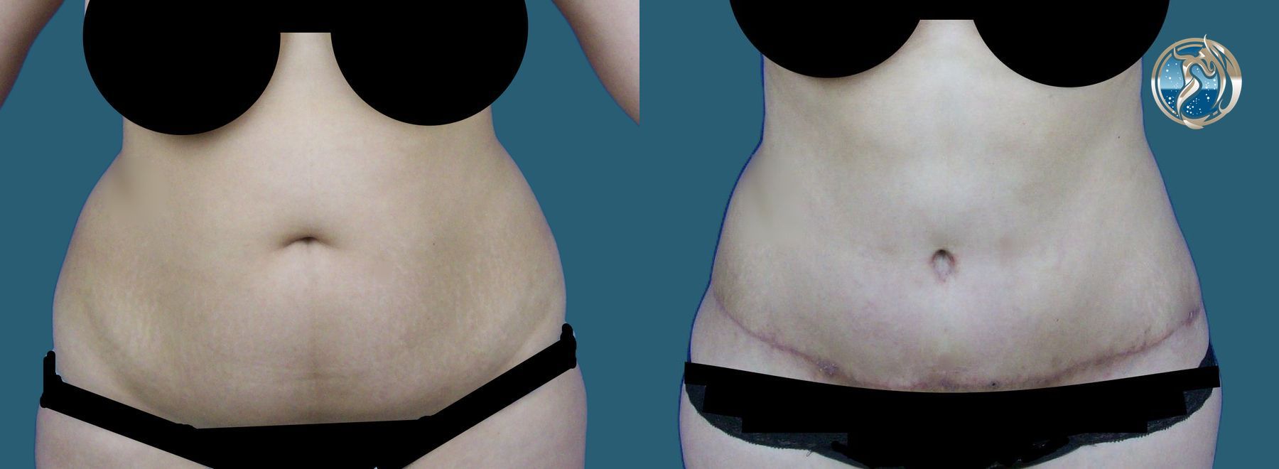 Before and after Liposuction and BodyTite minimally invasive surgical tightening case 43771